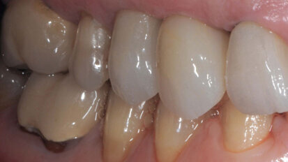 Ripristino Estetico-Funzionale di un canino fratturato