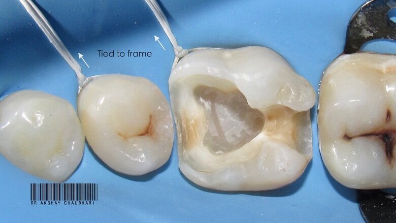Fig - 8 Floss Ligature