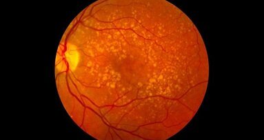 Учени откриват възможна връзка между слепотата и загубата на зъби при мъже