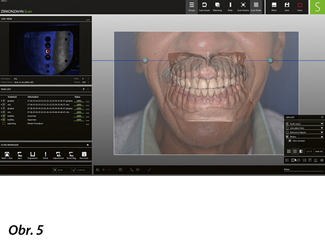 Nastavení individuálních parametrů konkrétního pacienta v programu Zirkonzahn.Archiv. V něm uložené údaje se importují do programu Zirkonzahn.Scan a dojde k fúzi dat.