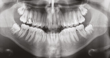 Stěsnání a protruze léčené nestandardními extrakcemi