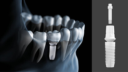 Straumann partners with Z-SYSTEMS to offer widest range of ceramic implants