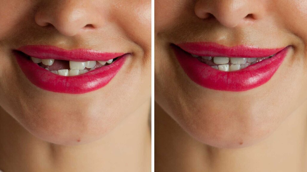 Nachwachsen neuer Zähne durch Medikament