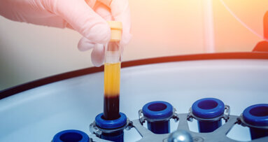 Migliori per l’osteointegrazione: i prodotti sanguigni autologhi di seconda vs terza generazione