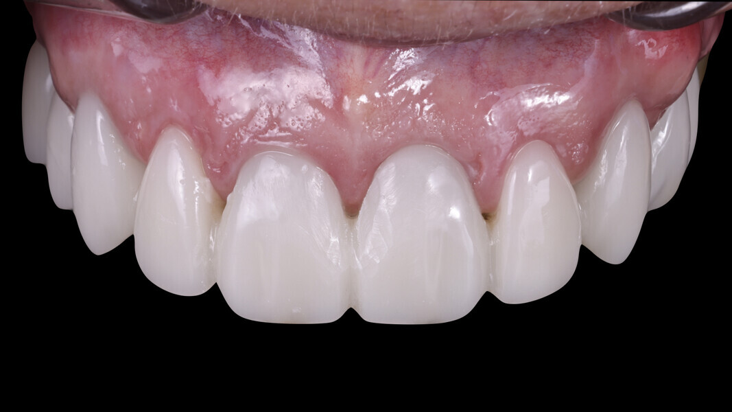 Fig. 24: Healing after four months.