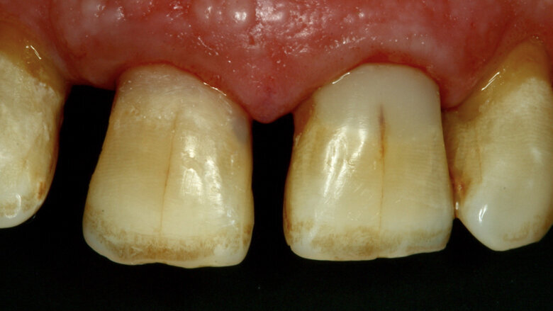 Figura 18. Restauración al remover el aislamiento.