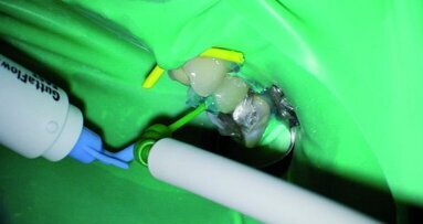 Acute endodontische problemen