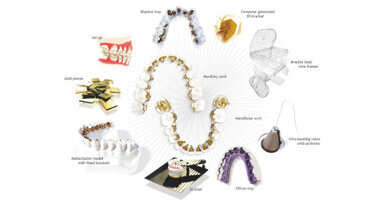 Non-extraction treatment of a Class II case with a missing mandibular central incisor using a CAD/CAM lingual orthodontic system