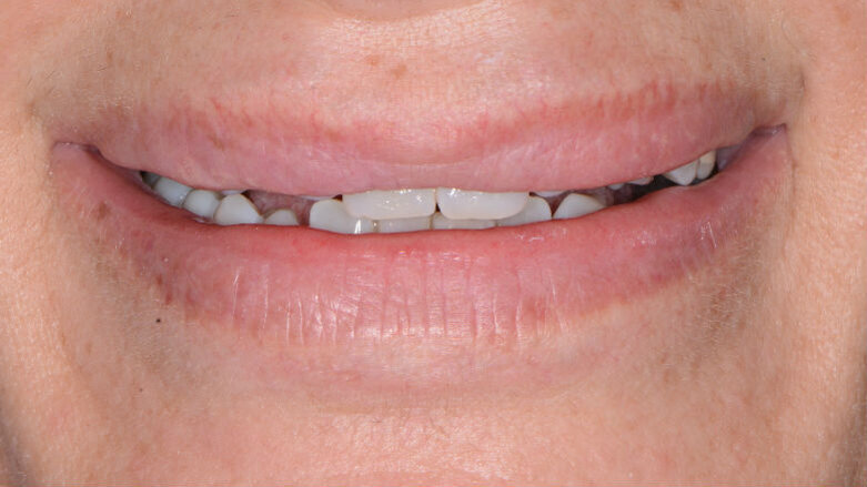 Esigenza di approccio interdisciplinare per l’armonia estetica del sorriso: case report