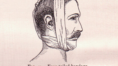 Meer bewijs nodig voor afbreekbare materialen in de kaakchirurgie