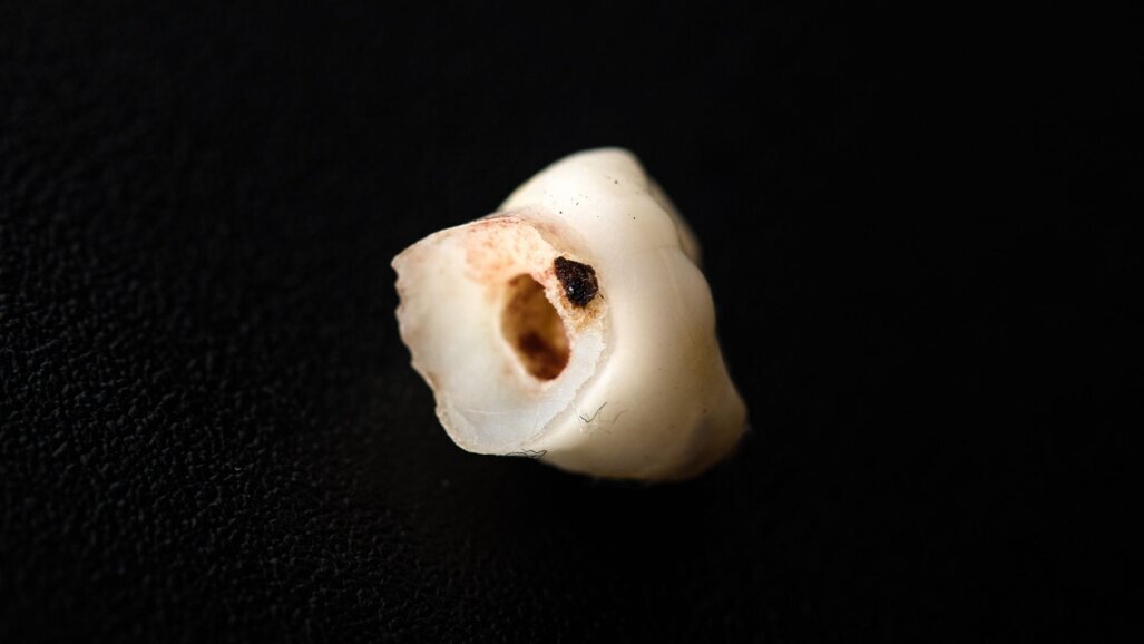 Nieuwe studie naar cariëspreventie pleit voor gecombineerde behandeling