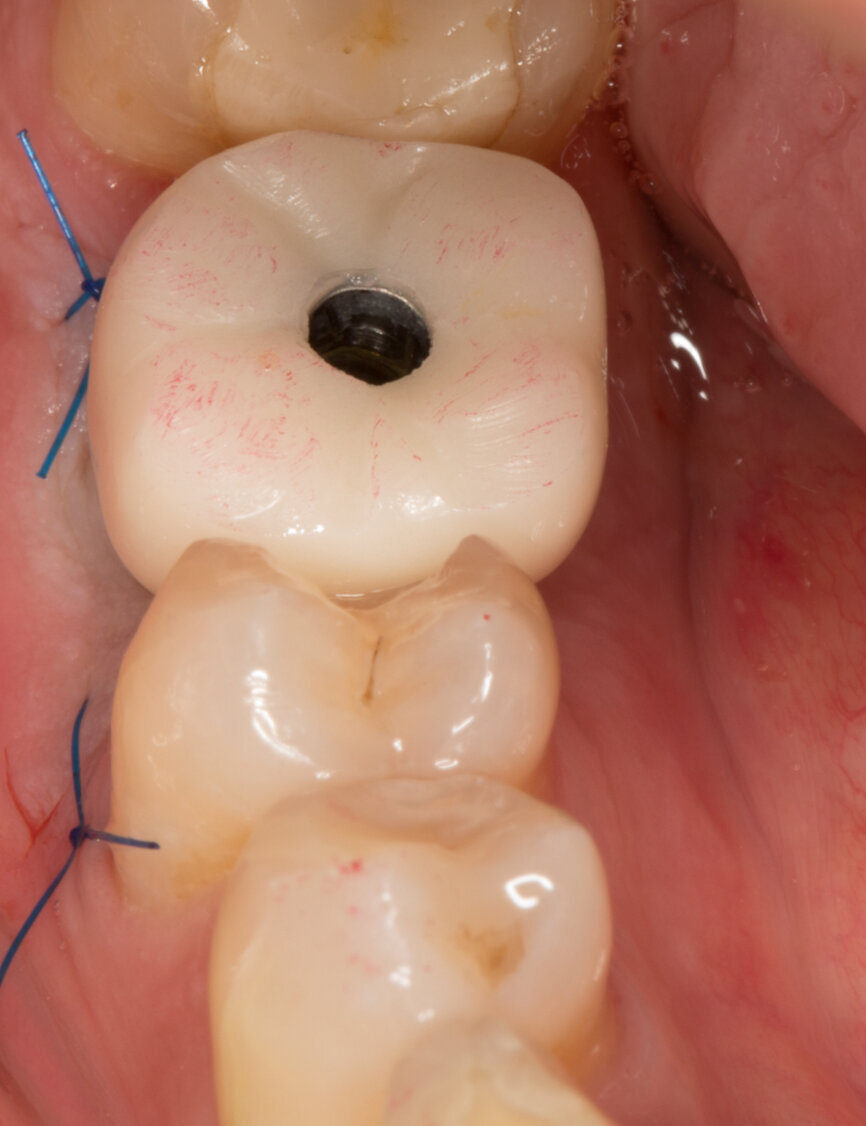 Ryc. 26-28_Osadzona korona tymczasowa przykręcana.

