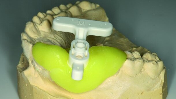 Traitement en une seule visite grâce à la CFAO et la CBCT