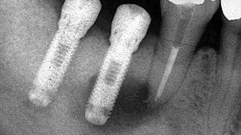 Periapikální léze implantátů a retrográdní periimplantitis – dva stavy nepříliš zdokumentované