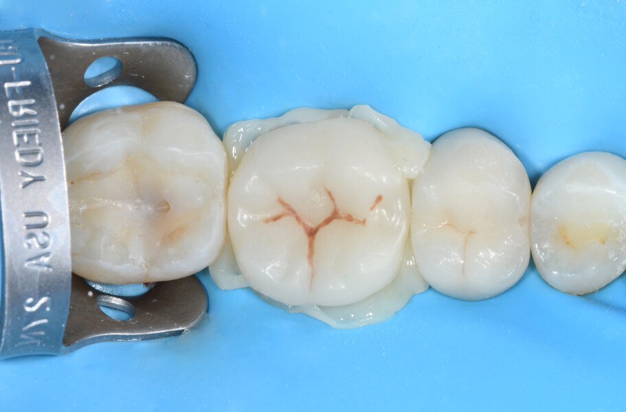 Fig. 11a: Endocrown after luting but before removal of excess material.