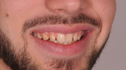 Riabilitazione protesica anatomicamente guidata