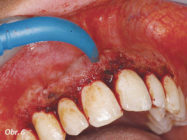 Odstraňování nežádoucích hyperplastických tkání pomocí diodového laseru AMD Picasso s jednorázovým hrotem.