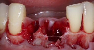 Vitamina D y Oseointegración