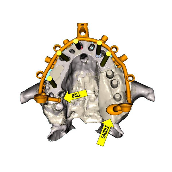 Fig. 10b: Occlusal view of the metal base frame attached to the maxillary model, resting on the posterior bone and soft tissue (yellow arrows).