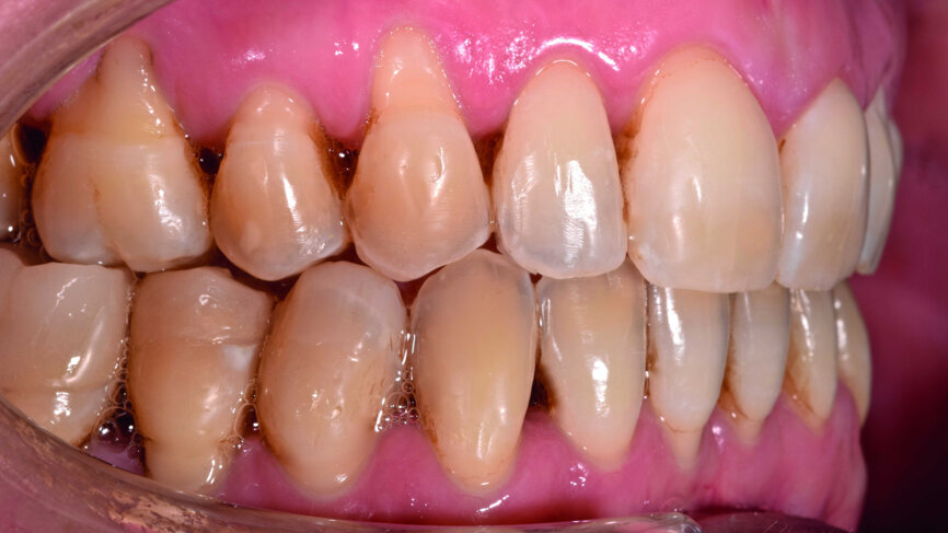 Fig. 18 : Vue latérale endo-buccale finale.