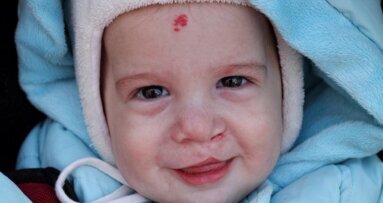 LCMD spreads awareness on Craniosynostosis and Distraction Osteogenesis