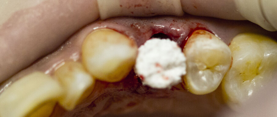 Fig. 5 - Posizionamento del biomateriale (cono R.T.R., Septodont) nell’alveolo.