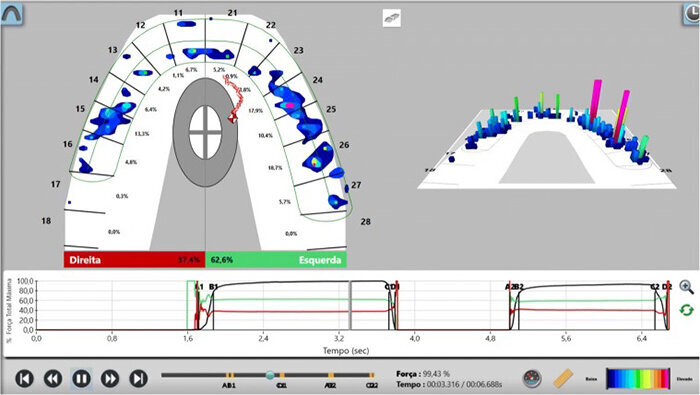 Fig. 16. Confirmación de la oclusión mediante tecnología T-scan.