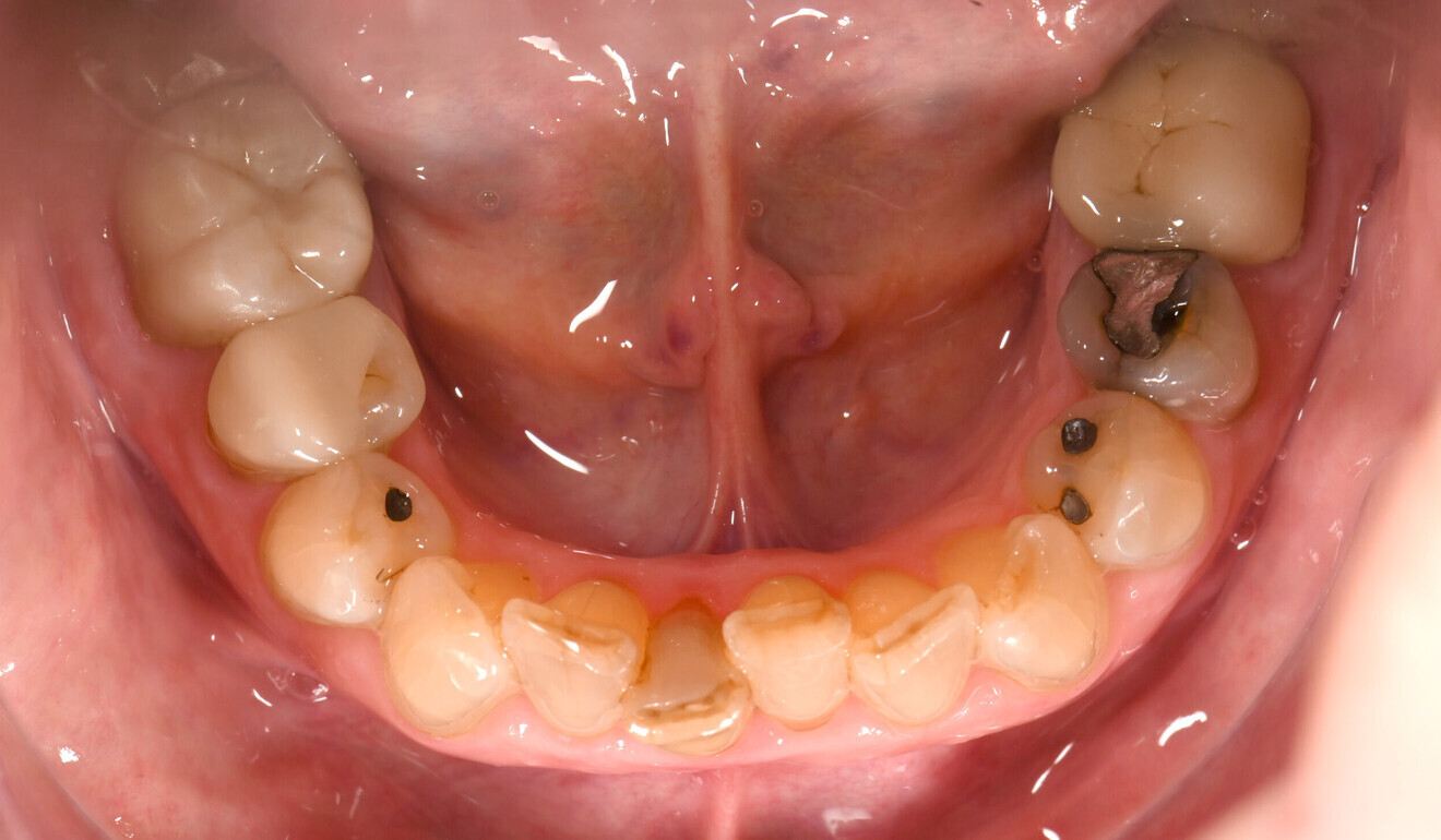 Fig. 3: Initial situation, occlusal view of the mandible.