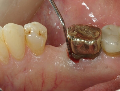 Fig. 2 - Aspetto clinico dell’elemento prima dell’estrazione, vista linguale.