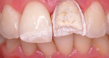 Laser Er:YAG et élimination des résines composites