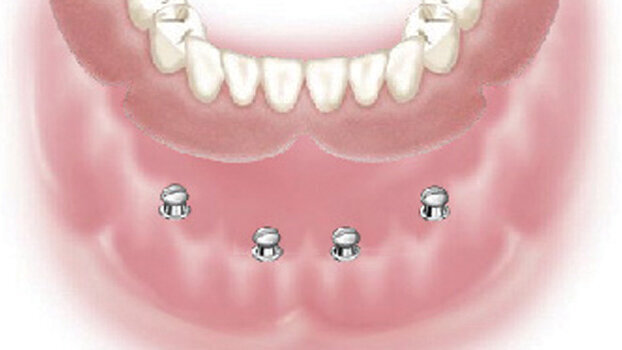 Henry Schein to distribute Dentatus