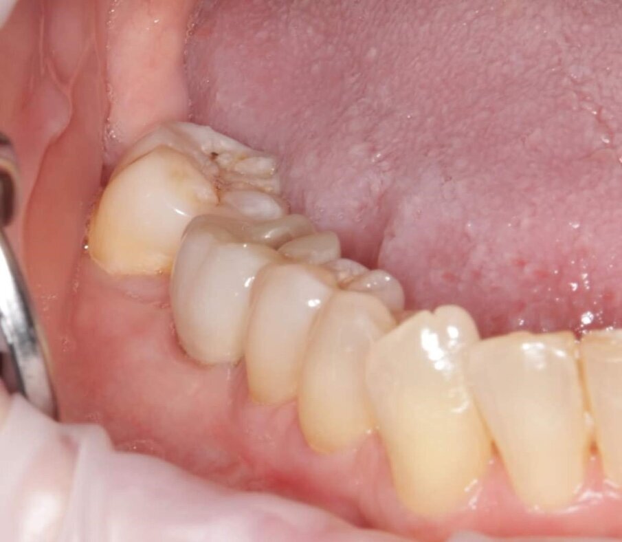 Fig. 27_Risultato clinico del sito 46 con corona in zirconia in situ dopo 2 anni e 7 mesi.
