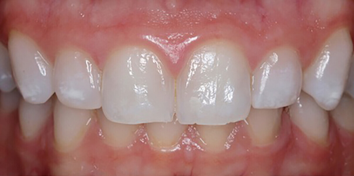 Fig. 5a: Maxillary canine to canine view after resin infiltration treatment. One-week follow-up.