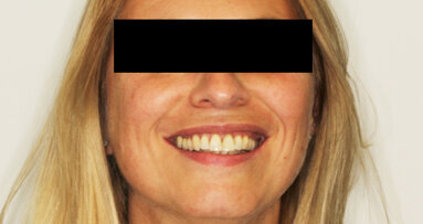 Matching of CBCT and virtual wax-up for single-tooth replacement of a central incisor