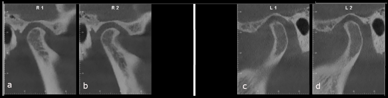 Figs. 56a–d: Post-treatment CBCT images of both temporomandibular joints (sagittal views). (a & b) Right. (c & d) Left.