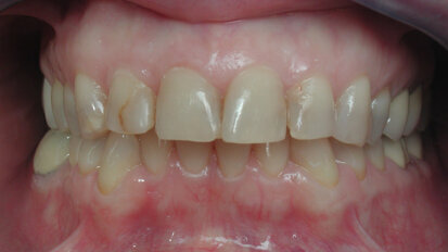 Sobre las carillas cerámicas