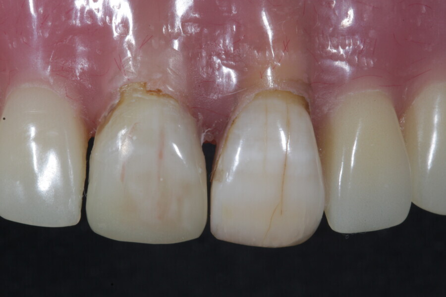 Fig. 19a: After finishing and polishing of the restoration.