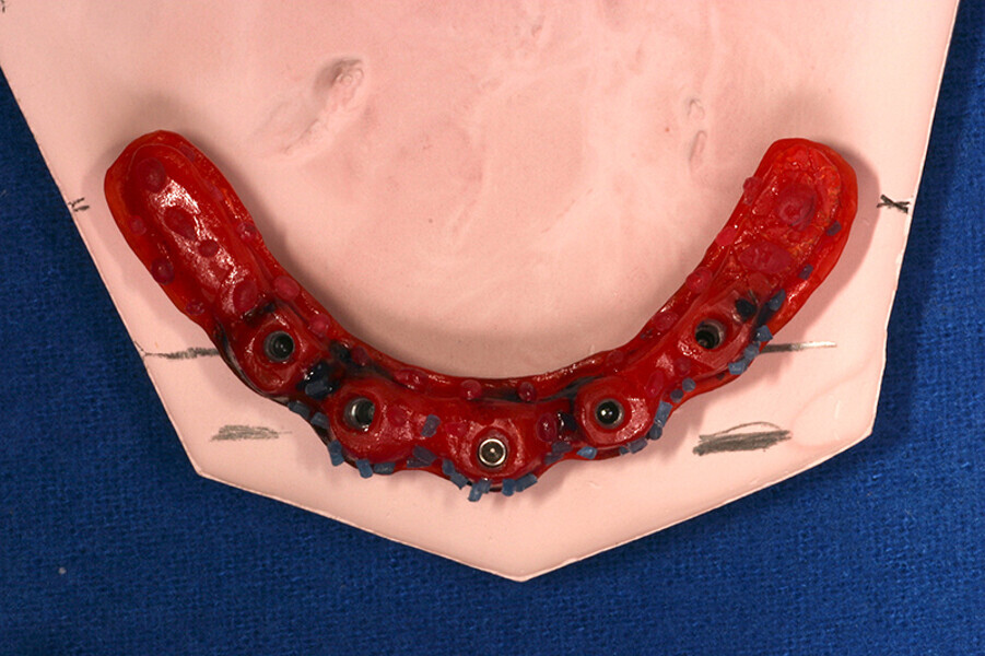 Fig. 2. Barra de Duralay® OSU, modelo rígido donde se fabrica la barra y barra metálica colada.