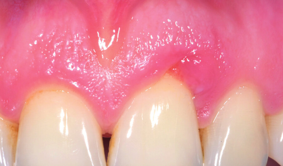 Fig. 2 - Guarigione a 5 gg. Tessuti ancora edemetosi. Viene fatta una terza applicazione di ozosan per 2 minuti.