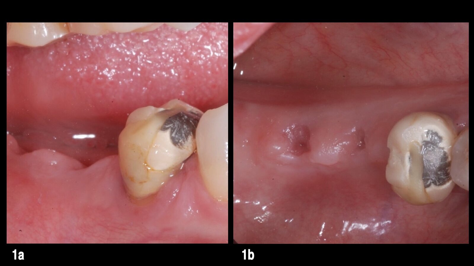 Restauración protésica sobre implantes desconocidos
