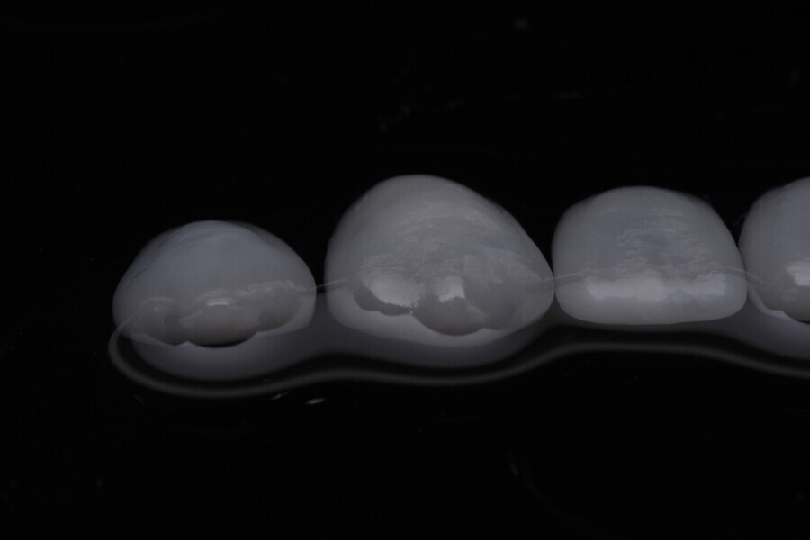 Fig. 14a–c: Veneers ready to deliver after adaptation and the manual texture procedure.