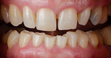 Tooth wear and bruxism: Dentistry’s hidden struggle