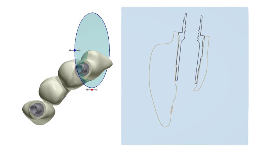 Fig. 39_Il progetto digitale consente all’odontotecnico di definire a livello circolare i limiti e gli spessori di rispetto della Zirconia.