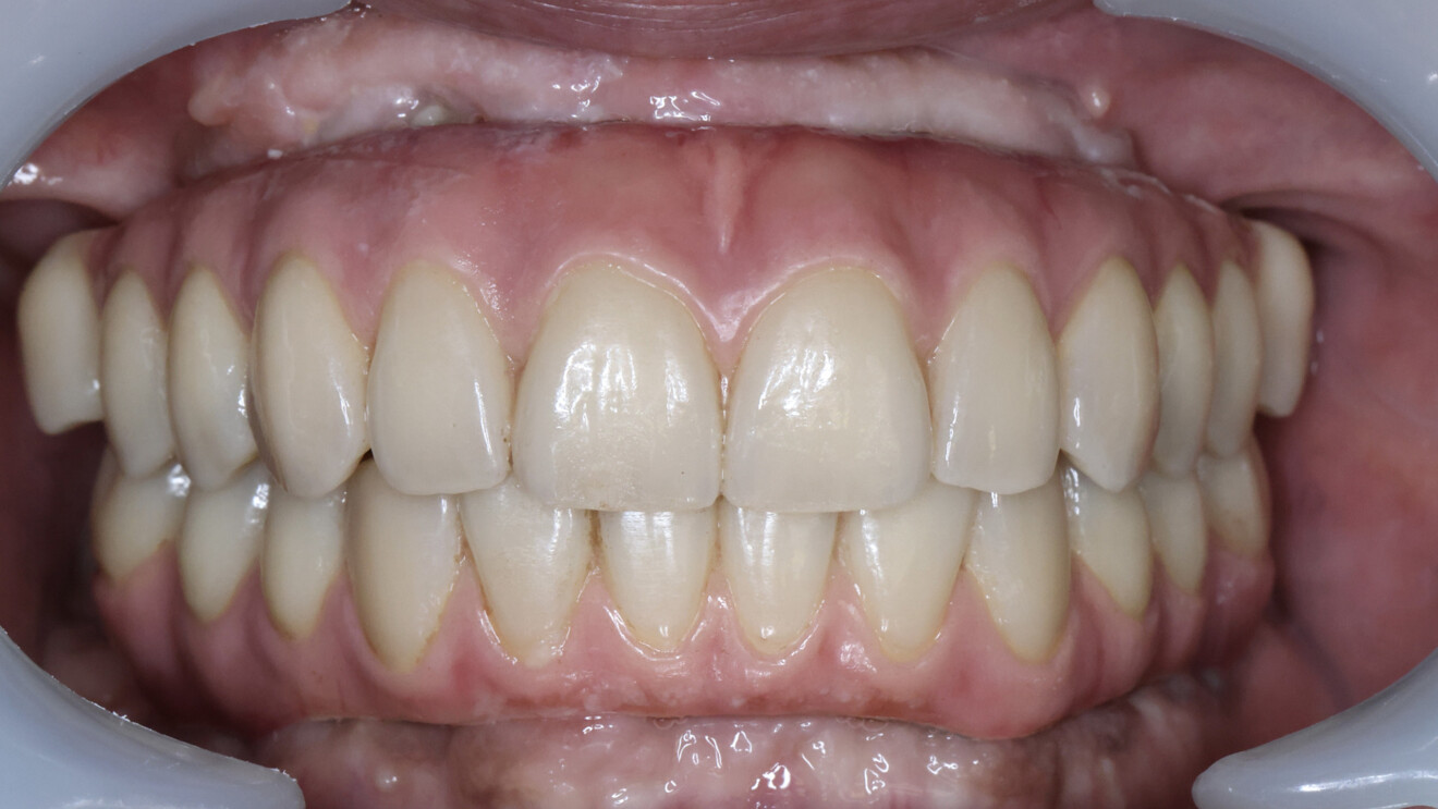 Fig. 20: Intra-oral frontal view of the maxillary and mandibular definitive prostheses in occlusion at the 16-month follow-up after delivery.
