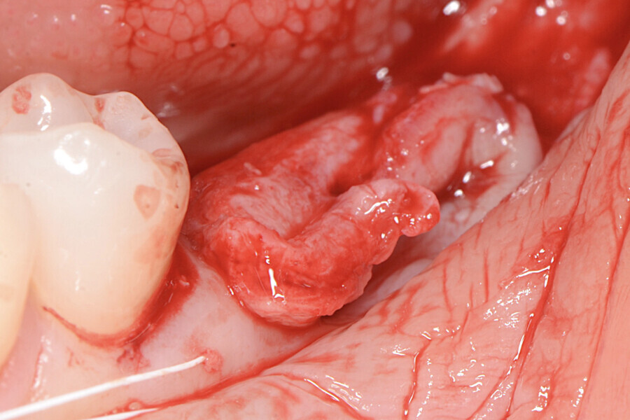 Fig. 12 : Greffe fixée en mésial par un fil de suture en PTFE.