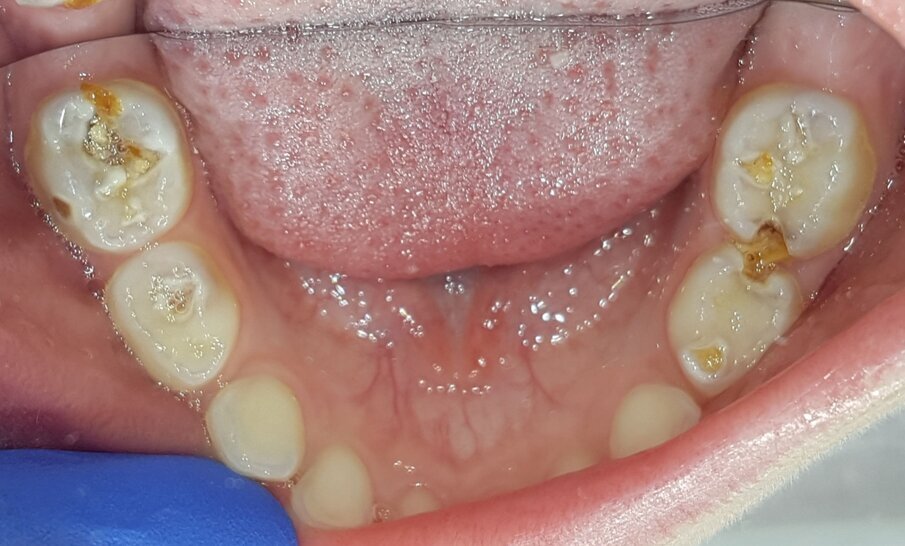 Afbeelding 6b. Multi-cariës bij intake.