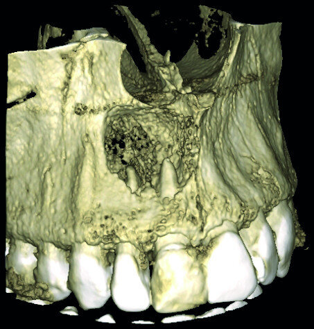 Fig. 2a: Conventional radiograph of an endodontically treated tooth #11 and cold-sensitive tooth #12 compared with CBCT imaging showing the presence of a large apical bone defect (taken at a two-day interval).
