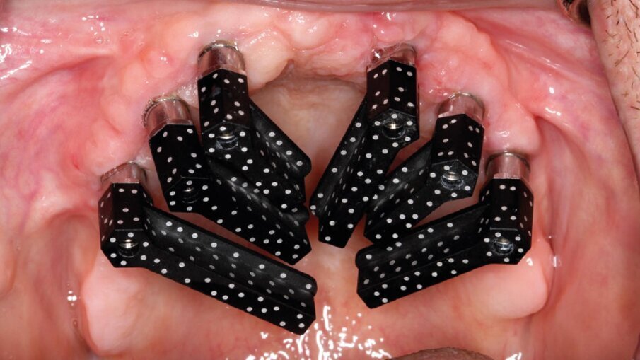 Fig. 4_Un singolo dispositivo è ora in grado di acquisire un’intera arcata di scan abutment codificati e la topografia dei tessuti molli mediante fotogrammetria intraorale.