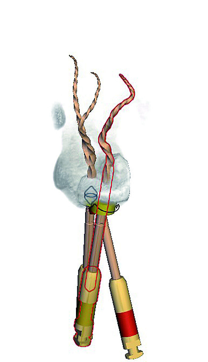 Fig. 13: Master files from a preloaded database of endodontic file systems are selected and projected in the root canal systems.