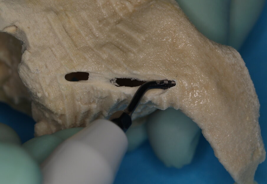 Figg. 9, 10 - Con lo stesso inserto a punta si lavora sulla corticale dello zigomo cercando di proseguire nella preparazione precedente.